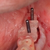 Surgical guide for dental implant placement