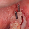 Surgical guide for dental implant placement