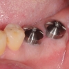 Dental implants healed