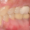 Final bite with implant supported crowns