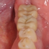 Lower dental implants restored with single crowns