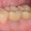 Final crowns on dental implants