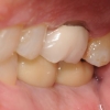 Final bite of implant crowns