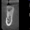 CBCT (dental scan) shows excellent bone