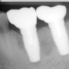 Final X-ray of crowns on implants