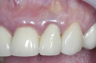 Infected upper incisor