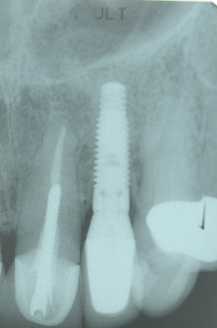 Final implant X-ray