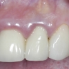 Infected upper incisor