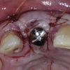 Implant placement