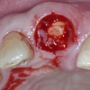 Extraction of tooth