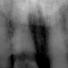X-ray of tooth with internal resorption