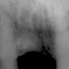 X-ray of extraction site at time of implant