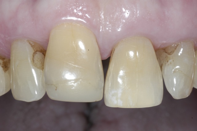 Resorption of upper front tooth