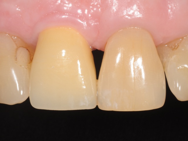 Natrual appearing crown on dental implant