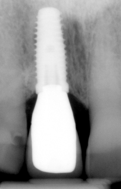 Final X-ray of dental implant