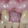 Bone graft to extraction site