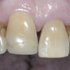 Resorption of upper front tooth