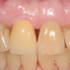Dental implant by Dr Kazemi