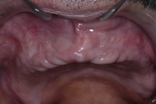 Complete missing teeth