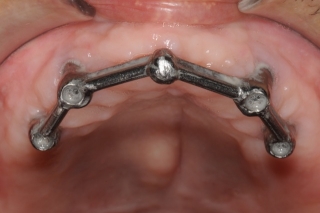 Implant supported bar