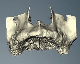 3-dimensional model from CT