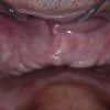 Complete missing teeth