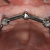 Implant supported bar