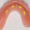 Denture with clips