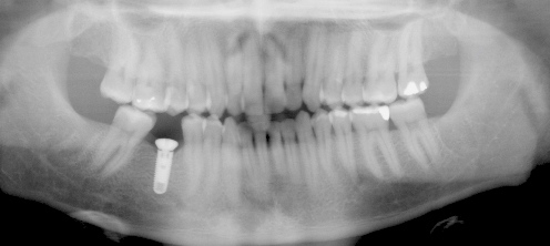 Single implant for replacement of lower right molar