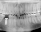 Single implant for replacement of lower right molar