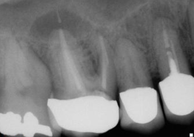 Tooth #3 molar with periapical abscess