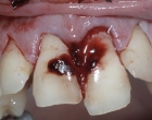 Fractured upper incisors