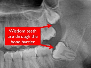 Impacted wisdom teeth- oral surgeon bethesda