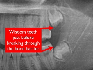 Impacted wisdom teeth- washington dc