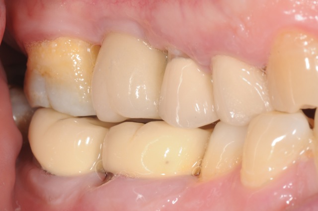 Final restoration and occlusion