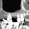 CT scan of molar extraction site