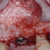 Bone graft to sinus lift area