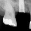 Implant X-ray