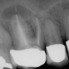 Extraction of a molar with abscess
