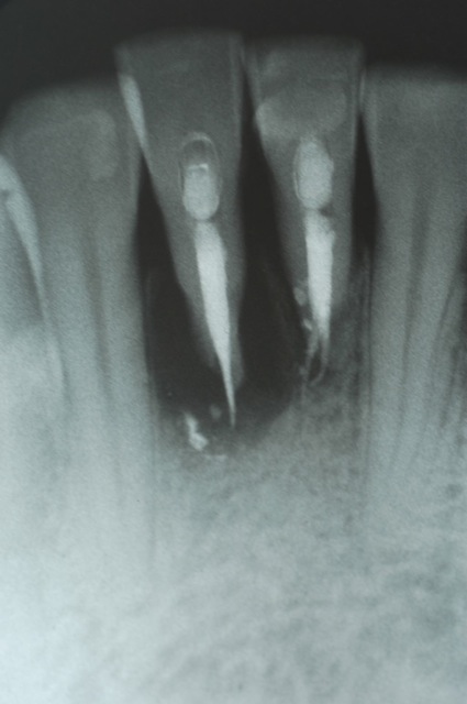 periodontal-abscess