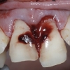 fractured-broken-teeth