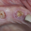 non-restorable-teeth