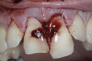 broken upper teeth