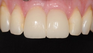 final crowns on implants