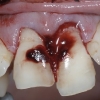 broken upper teeth