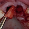 Extraction of broken teeth