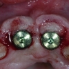 dental Implant exposure