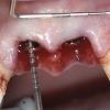 Position of dental implants