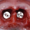 Immediate dental implants