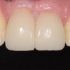 final crowns on implants